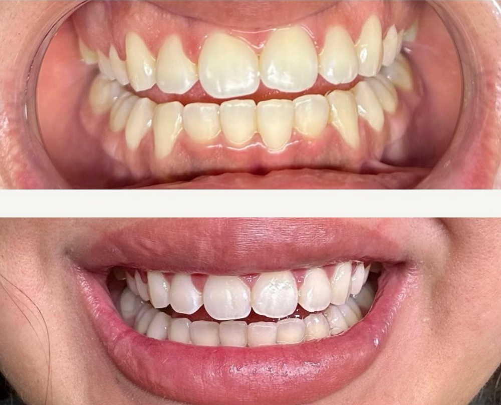 🦷30min Teeth Whitening Session