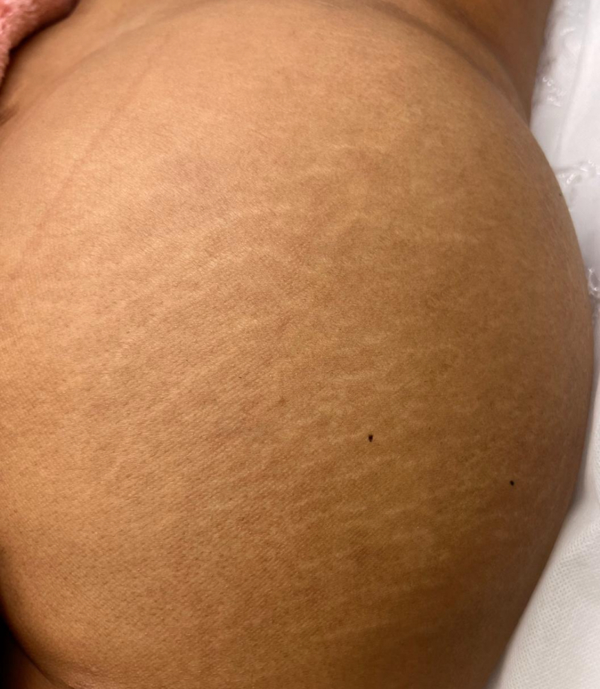 Inkless/Camo Stretchmarks Buttocks