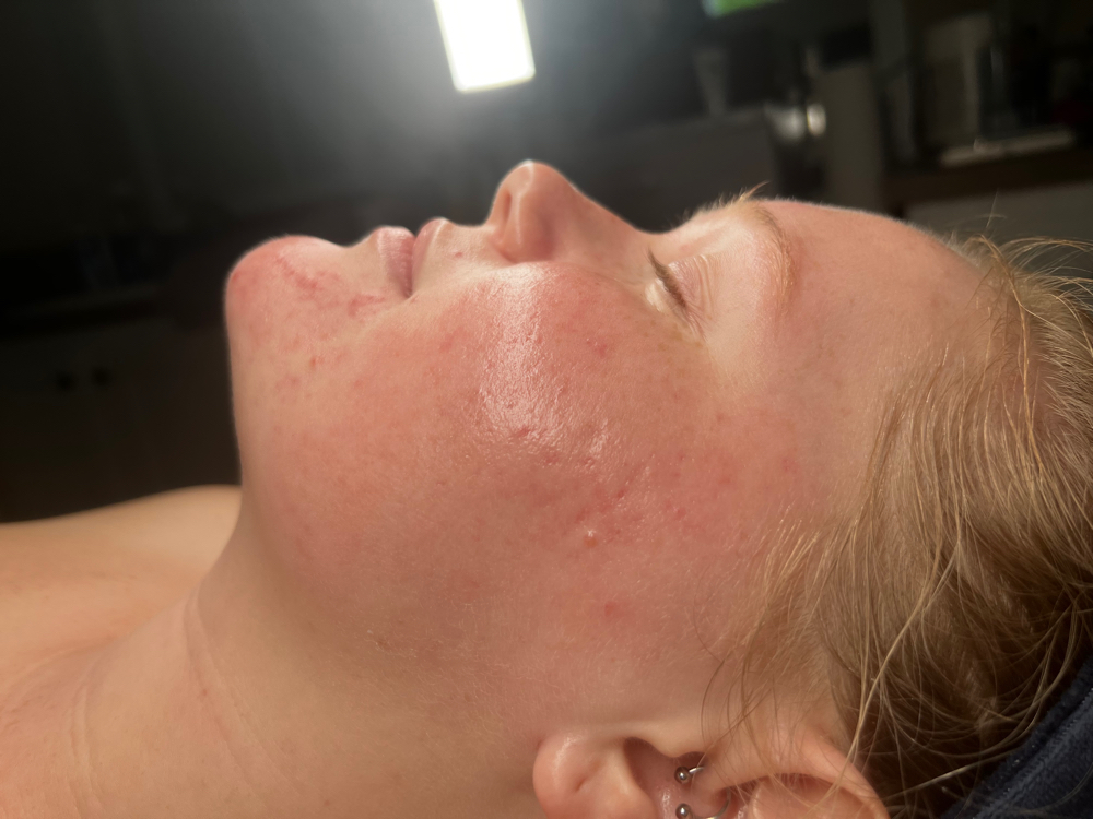 Acne Facial