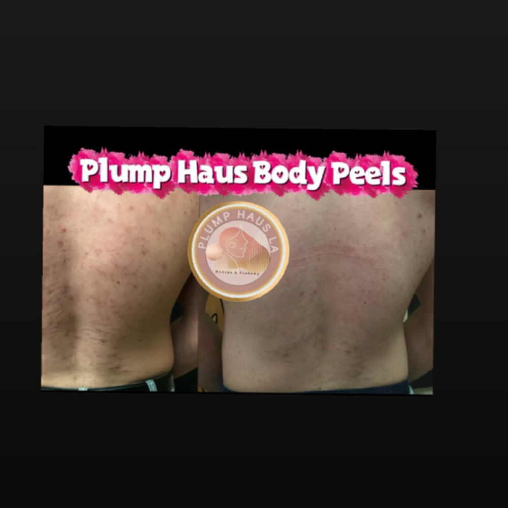 Skin Bright BACK Treatment at Plump Haus LA in Beverly Hills, CA