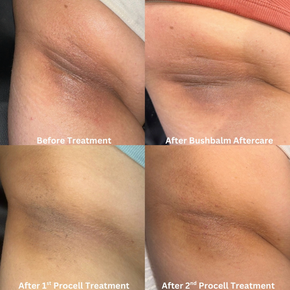 Underarm Brightening with Procell at Perez Esthetics in Columbus, OH