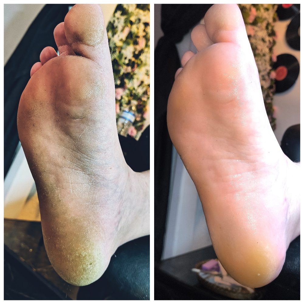 Foot callus treatment