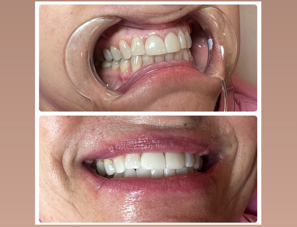 60 Min Teeth Whitening Session