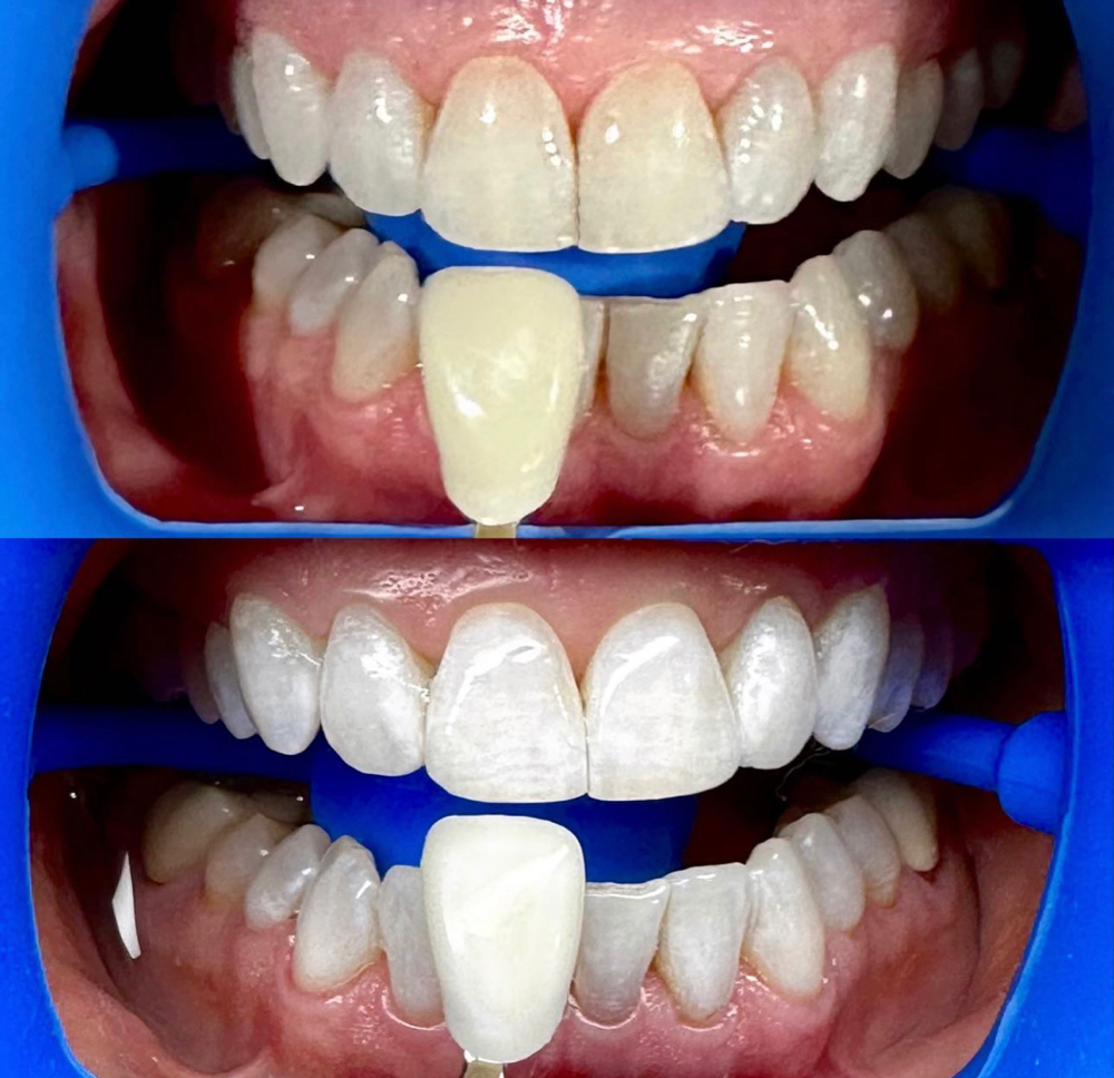 Teeth Whitening