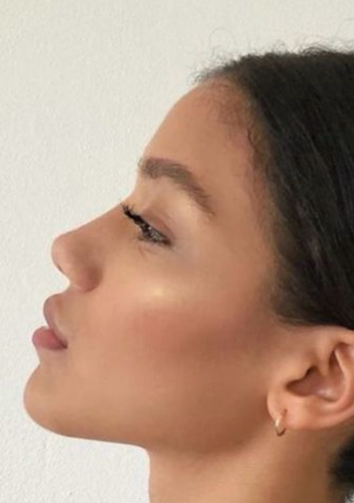 Kybella® Fat Dissolving Treatment