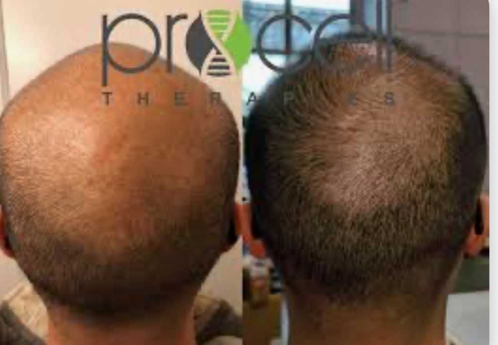 ProCell Hair Restoration