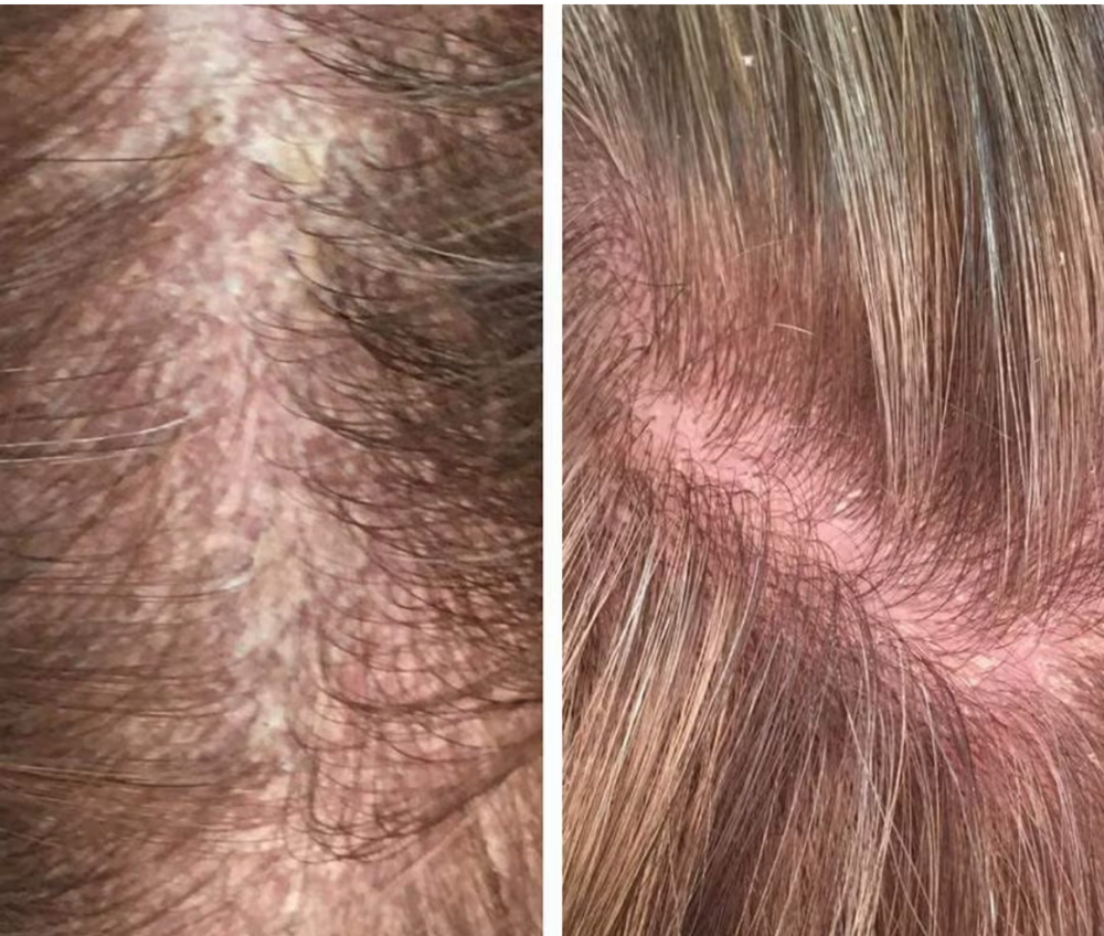 Hair Braiding Scalp Exfoliation