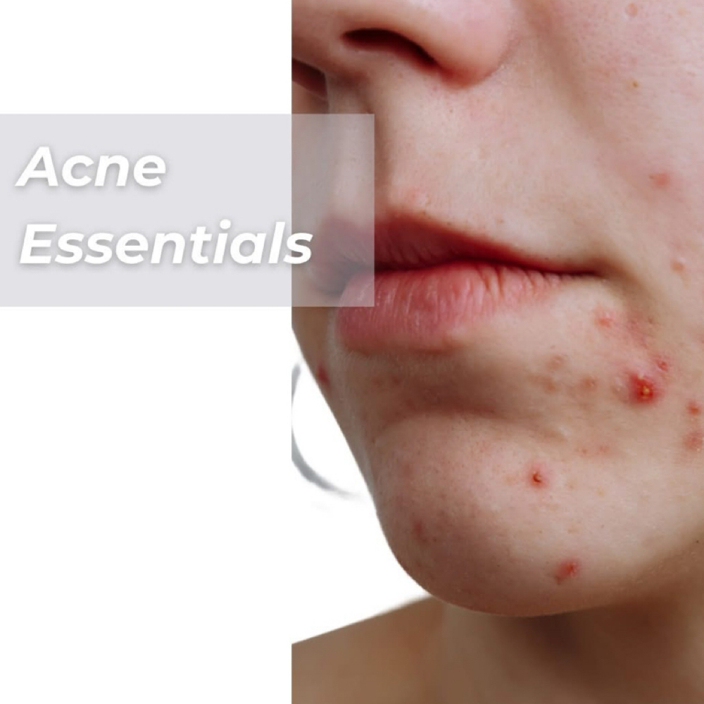 Acne Treatment - Program Member at Holistic Skin Center in Edgewater, FL