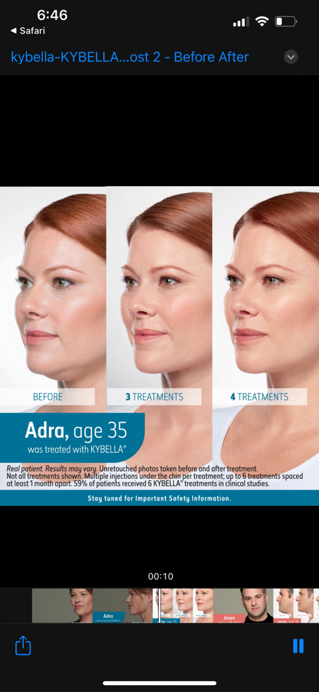 Kybella Treatment Package Of 2