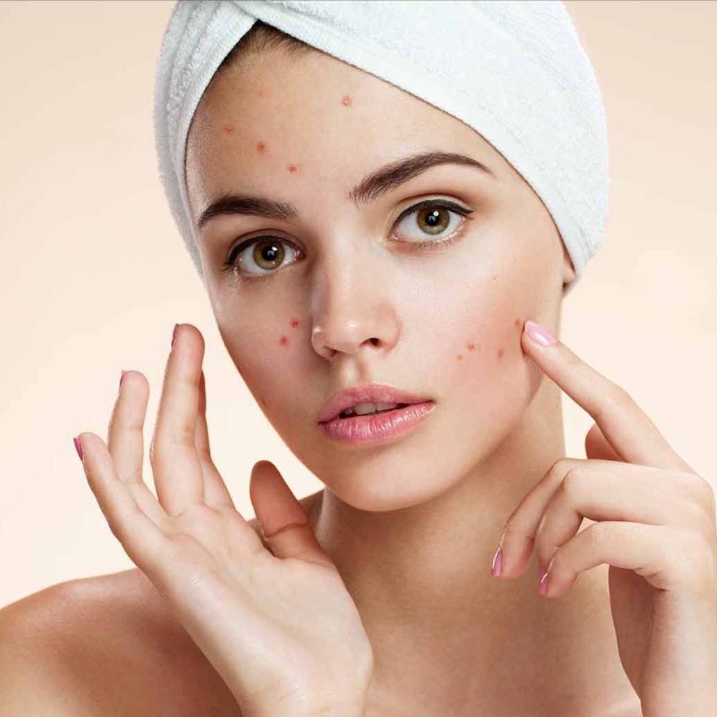 Acne Facial