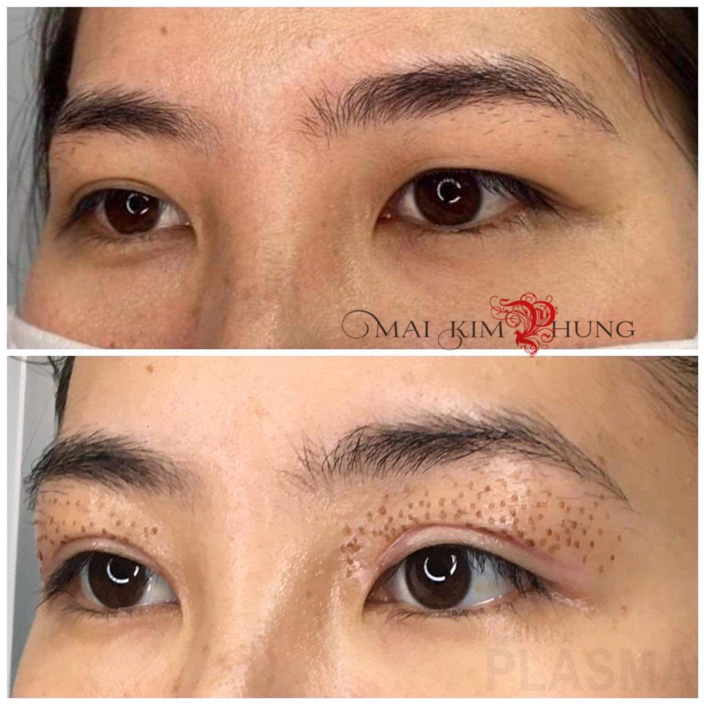 NON SUGERY BDOUBLE EYELIDS