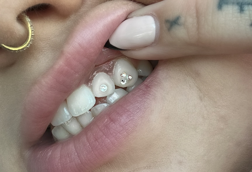 Tooth Gems