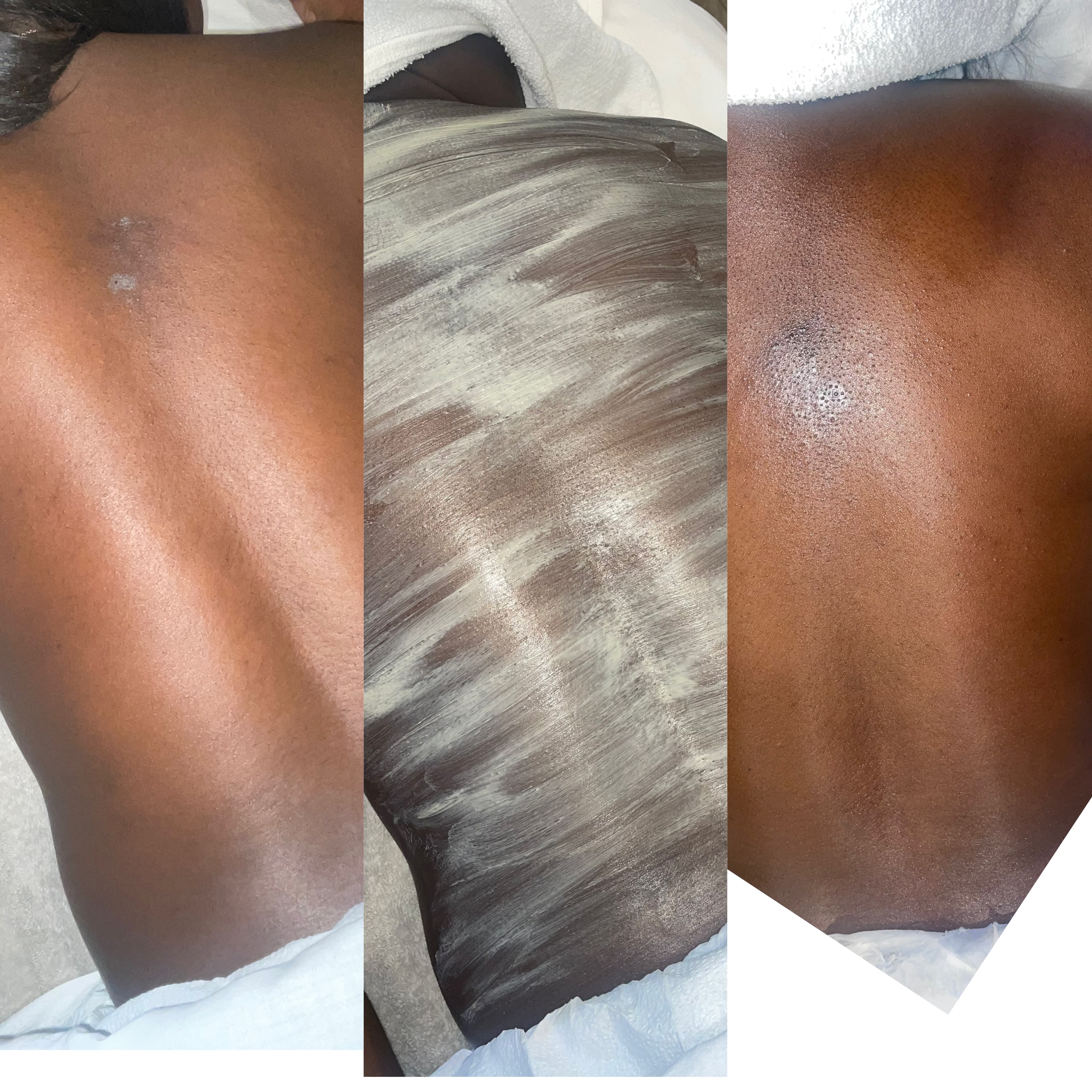 Back Treatment at Elegant Beautie in Birmingham, AL