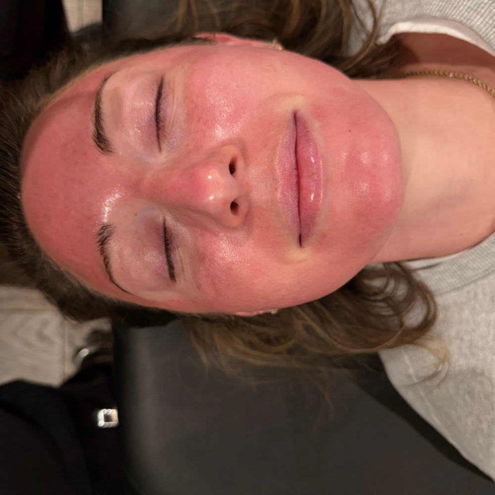 Advanced microneedling at Atelier Aesthetics and Infusions in Dallas, TX