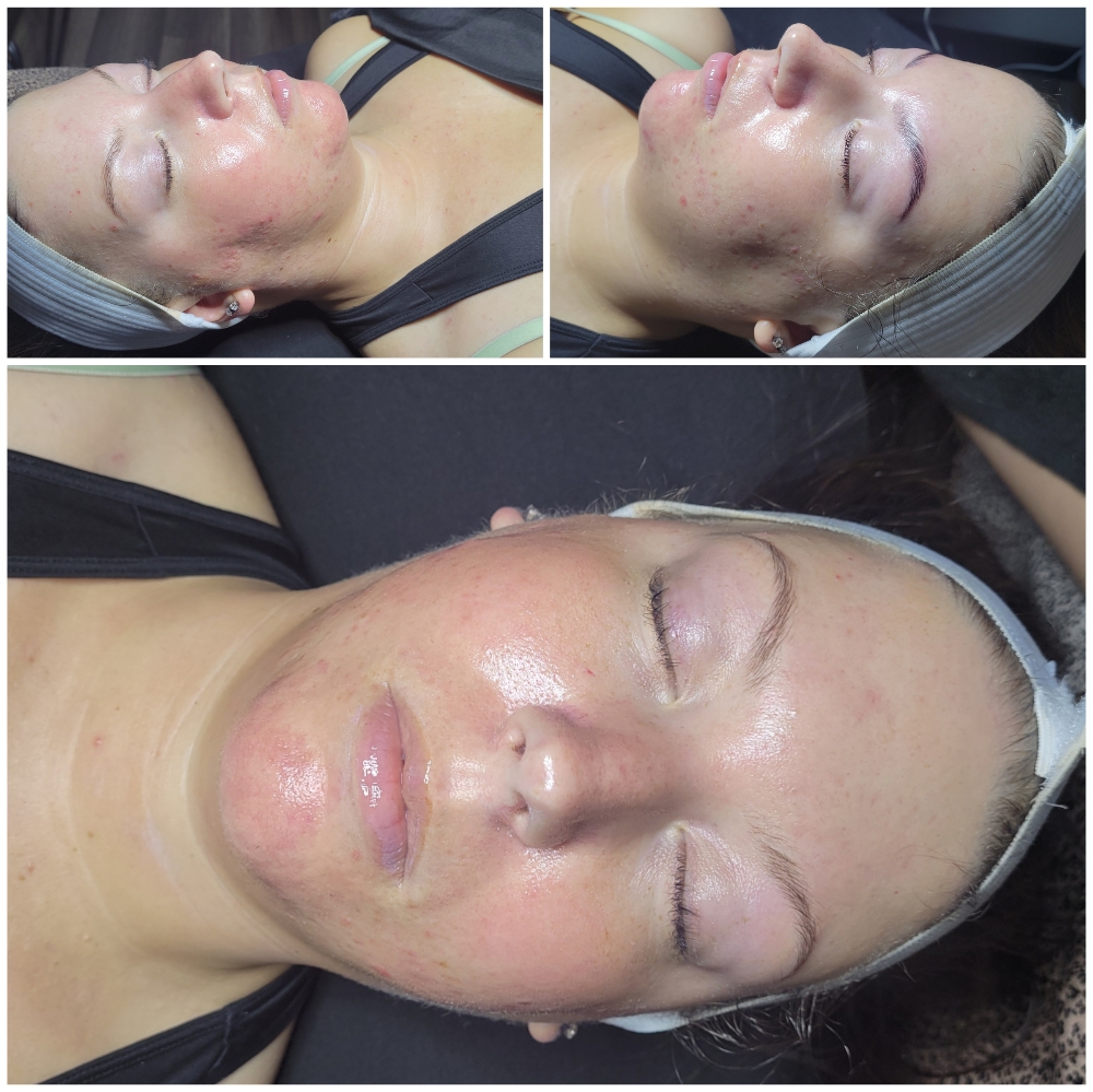 ACNE Facial