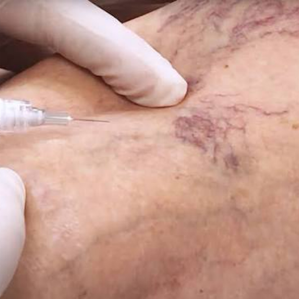 Sclerotherapy at All Things New Med Spa in Pollok, TX