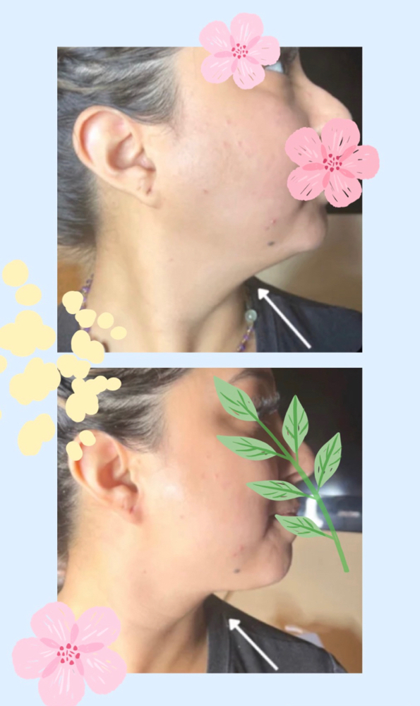 Non Surgical Chin Lift