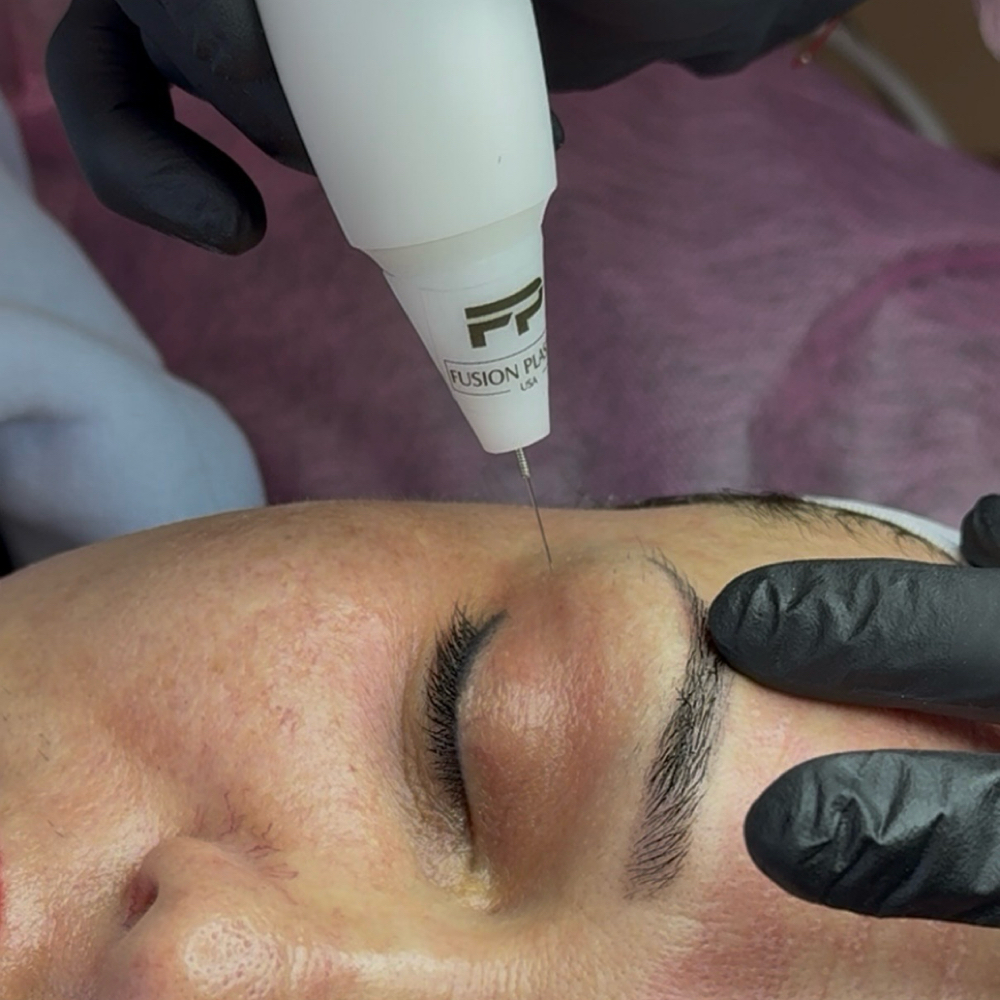NON-SURGICAL BLEPH - EYELIFT at Beauty and Brows in Queens, NY