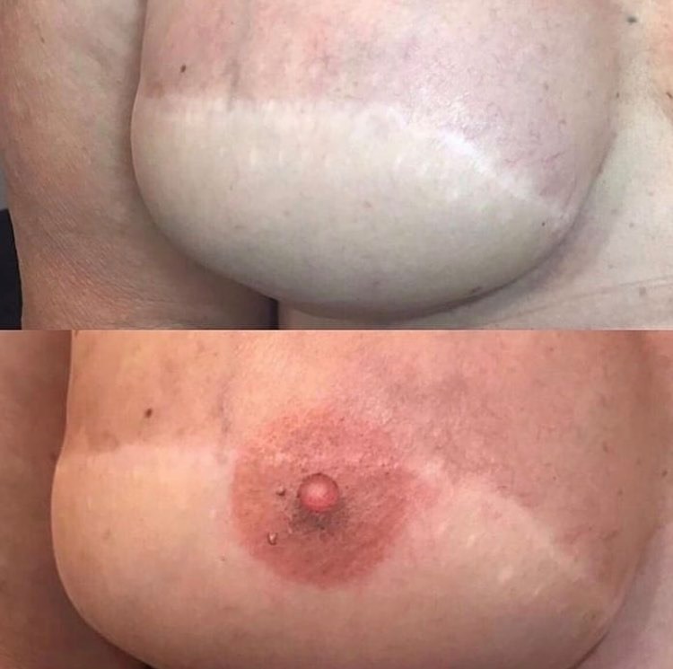 Areola Restoration