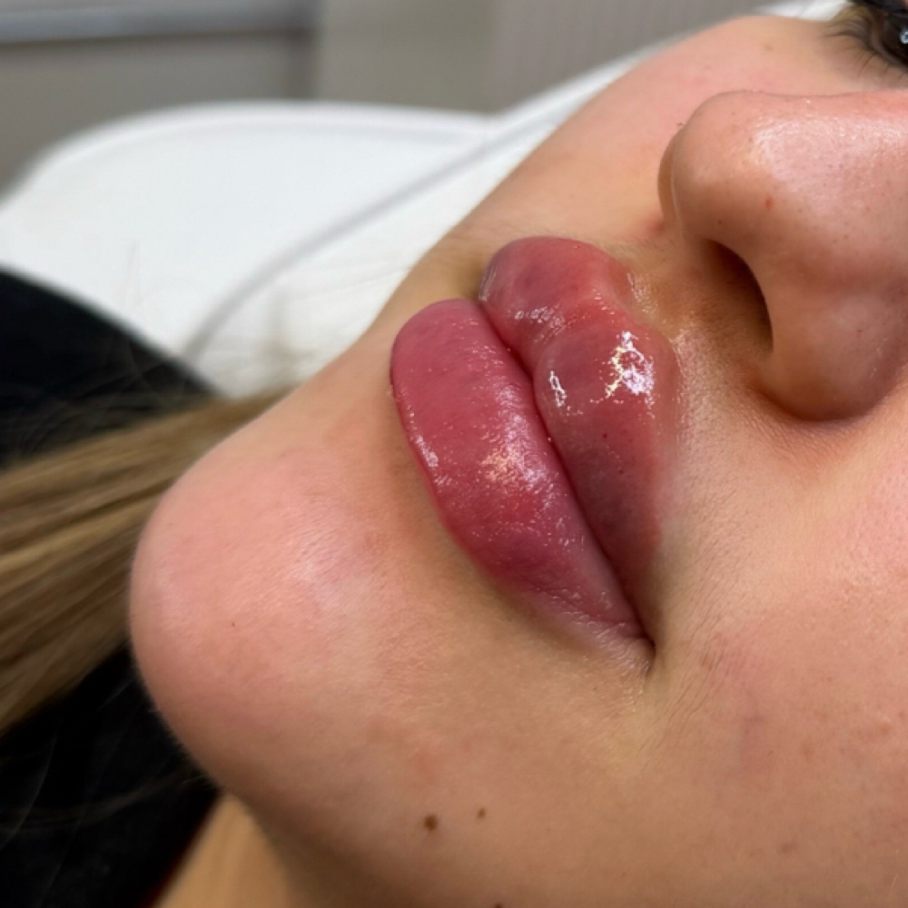 Lip filler 1 ML at Elevé Esthetics in Chicago, IL