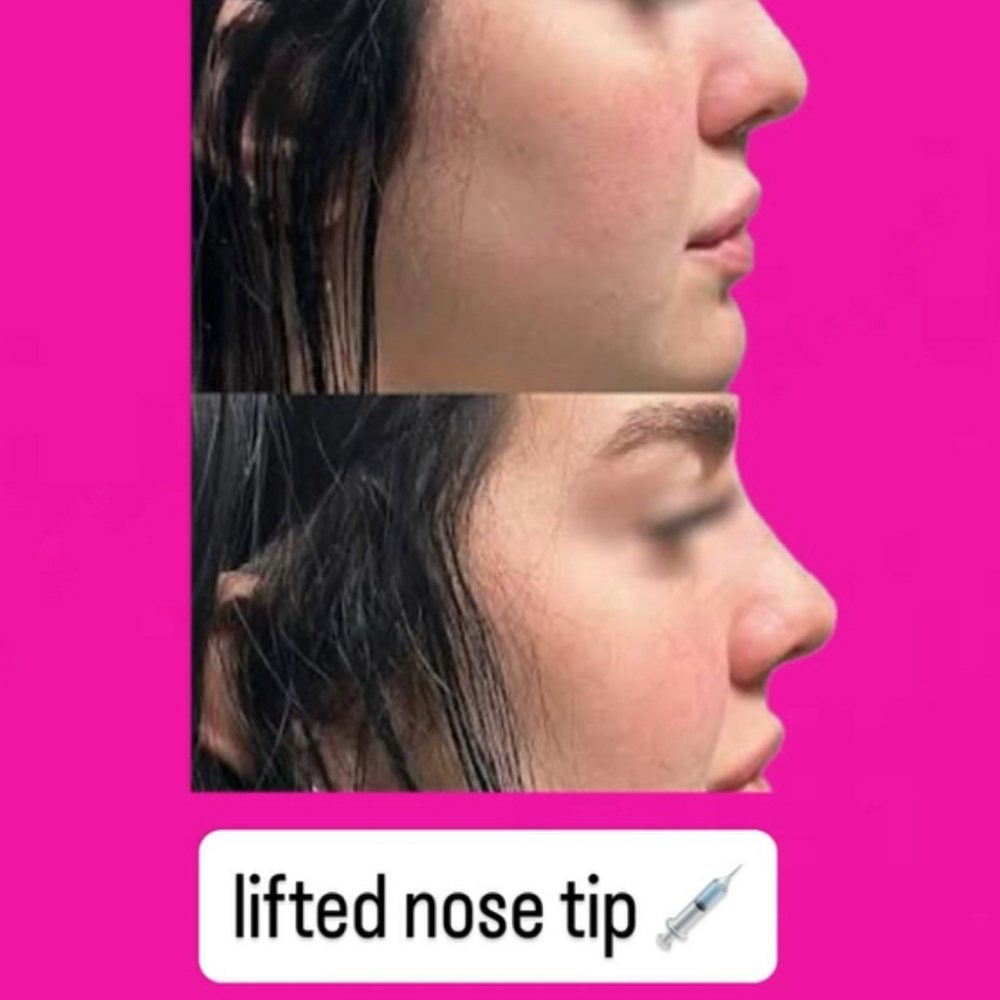Nose Lift at Pure Bliss Studios in Fort worth, TX