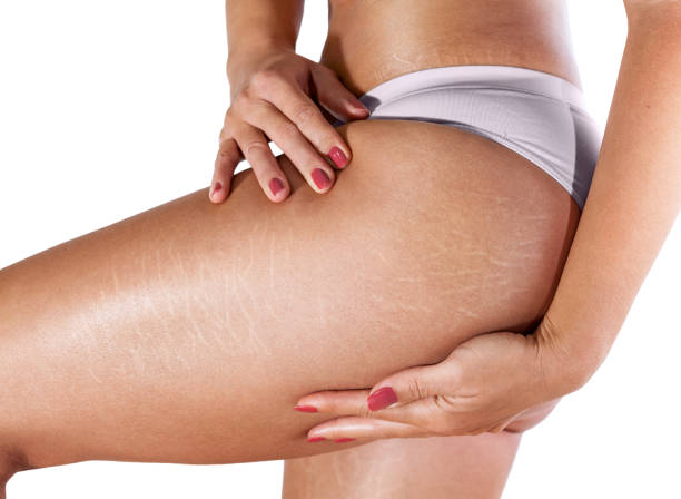 Scar/Stretchmark PRP Microneedling