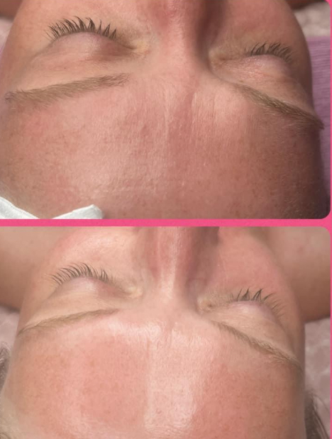 HydraDermabrasion Facial