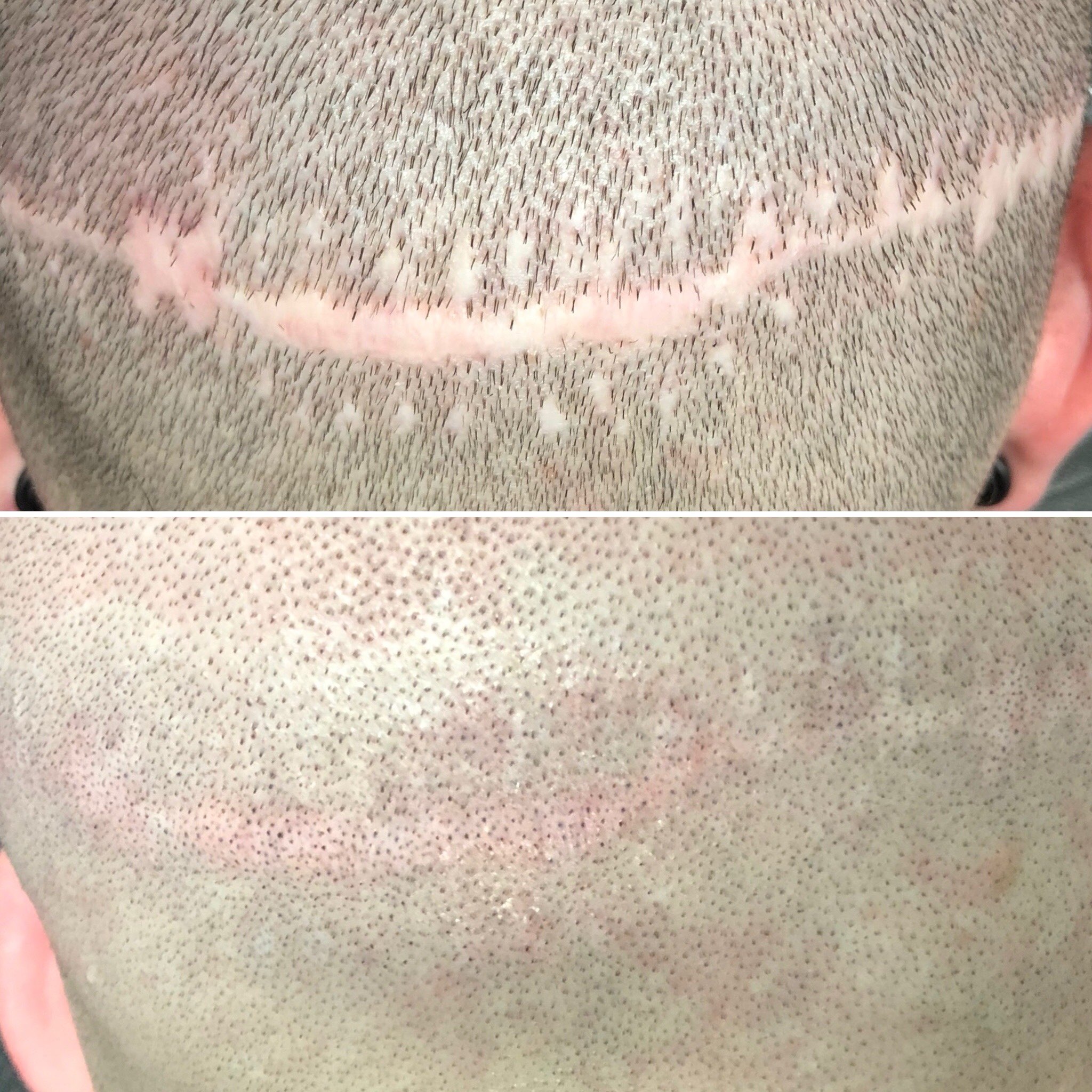 Scalp Micro Scar Revision