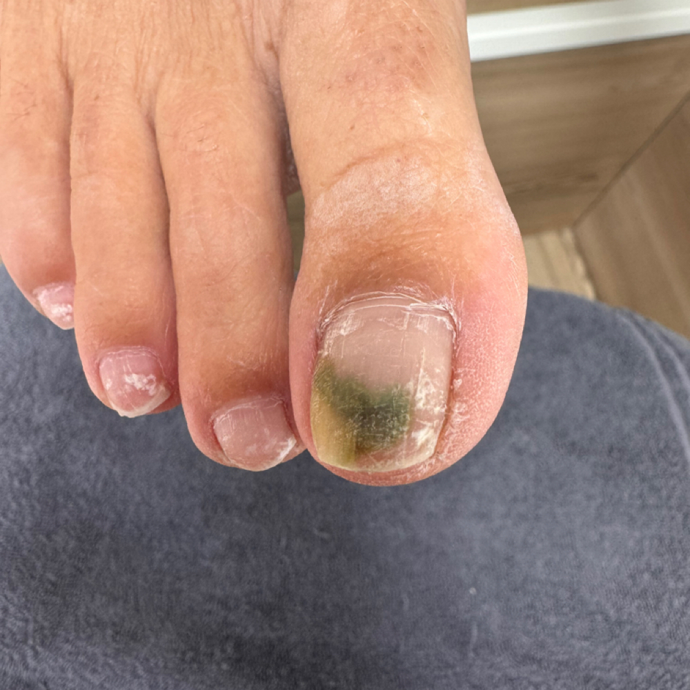 Bactiria Debridement at Southern Oregon PEDICURE CLINIC in Medford, OR