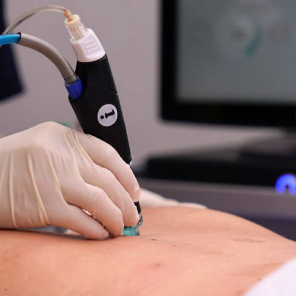 Hydrafacial- Upper Back at APMU MED SPA | Atlanta Aesthetics & Permanent Makeup in Marietta, GA