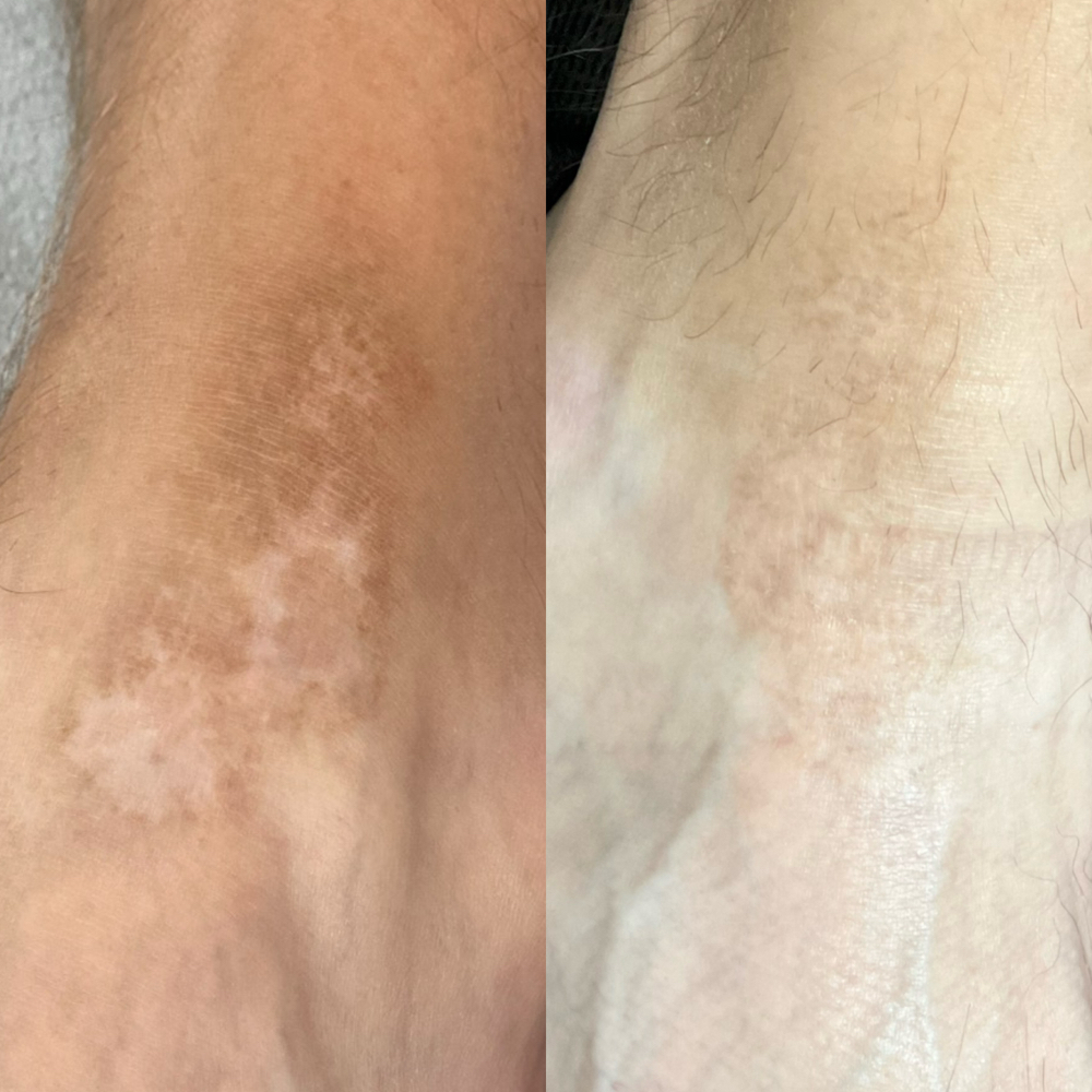 Scar & Stretch Mark Camouflage