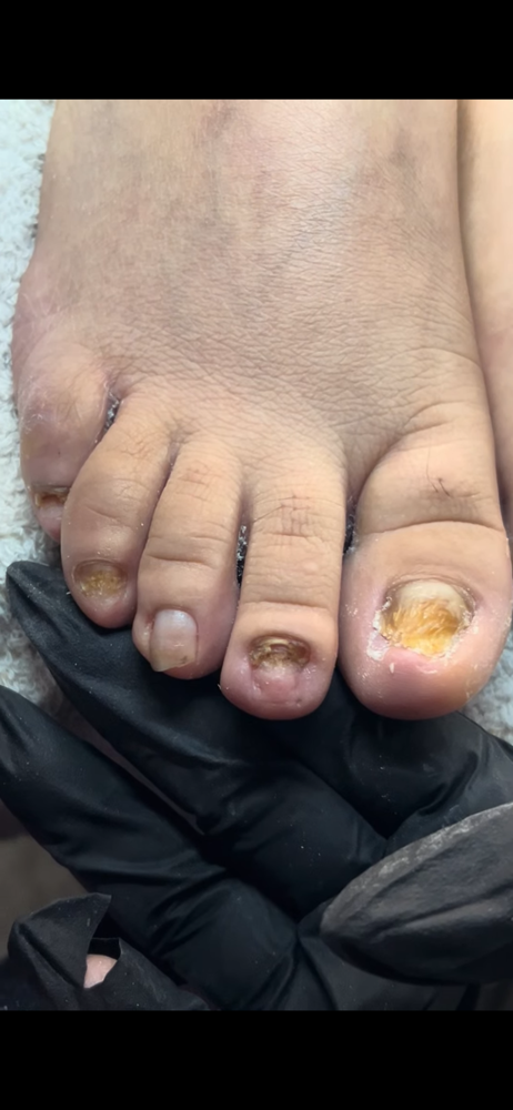 ACRYLIC MILD FUNGUS at NailsByChachiis in Colton, CA