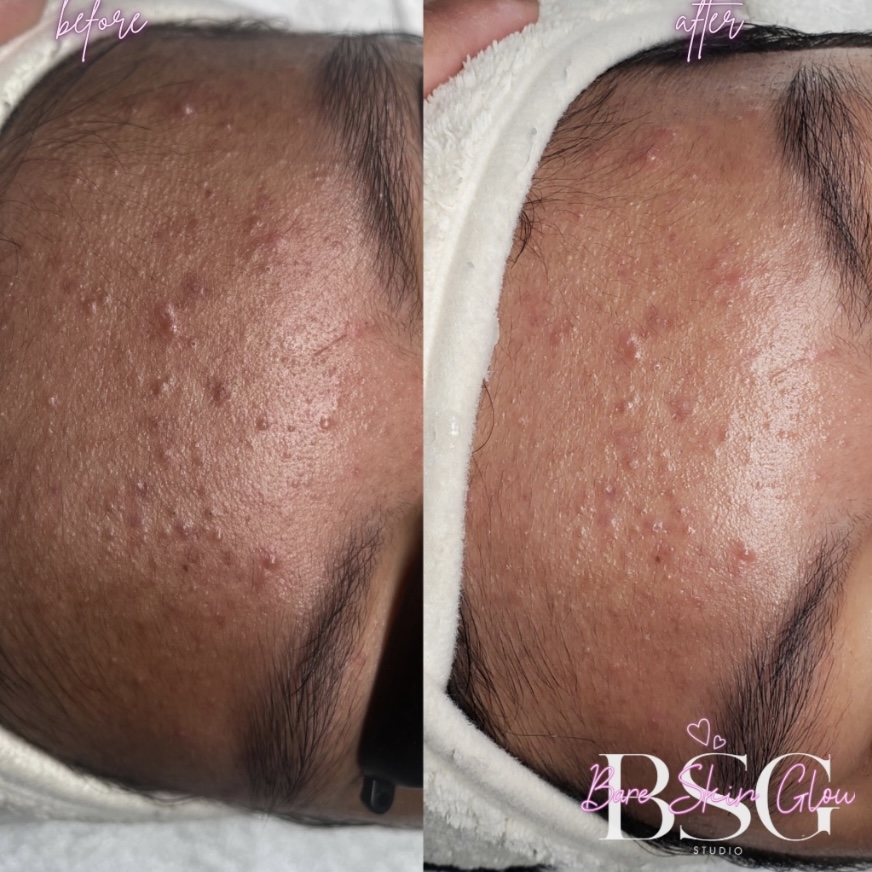 Acne Facial