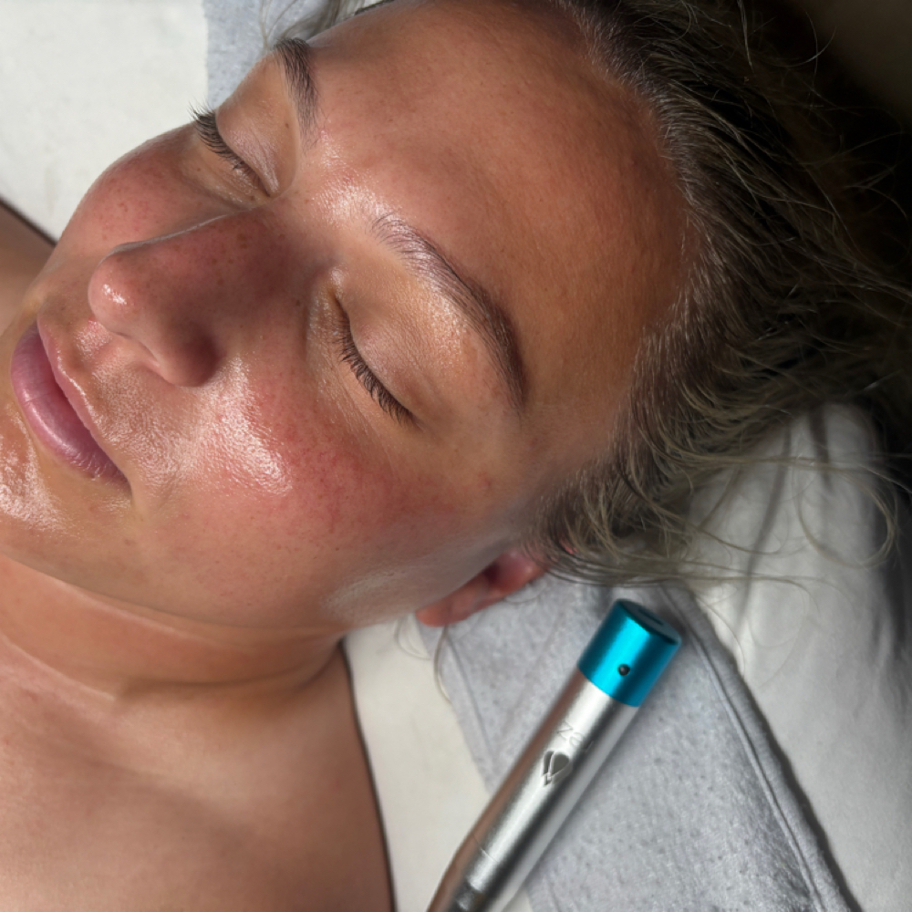 Rezenerate Nano Facial at Aesthetics by Abby in Alliance, OH