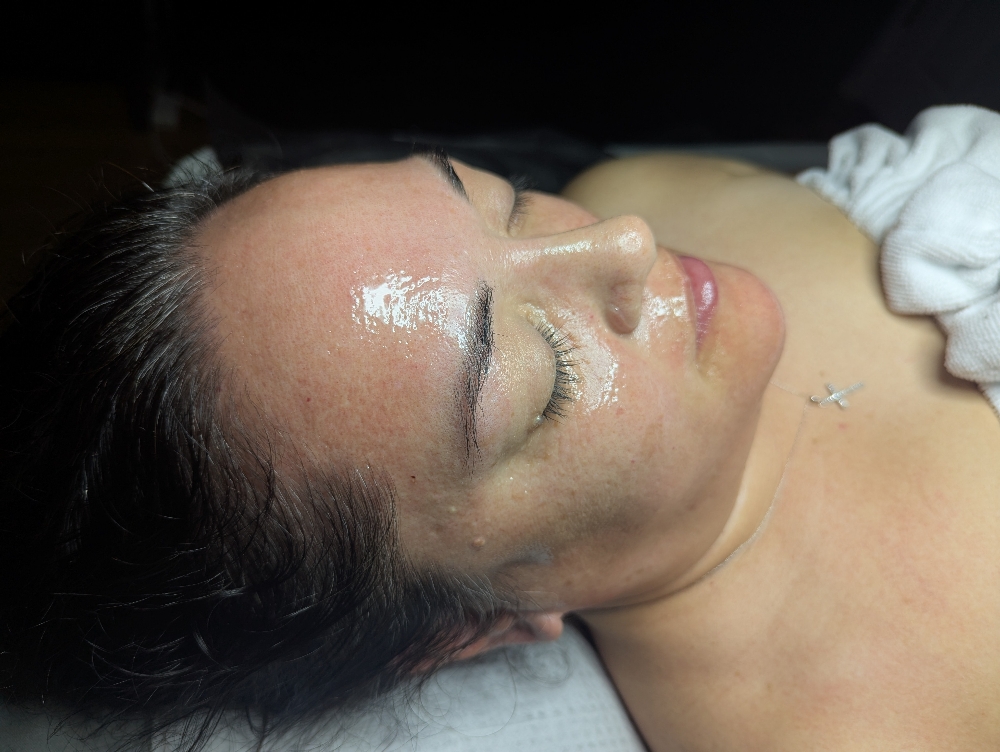 Chemical Peel
