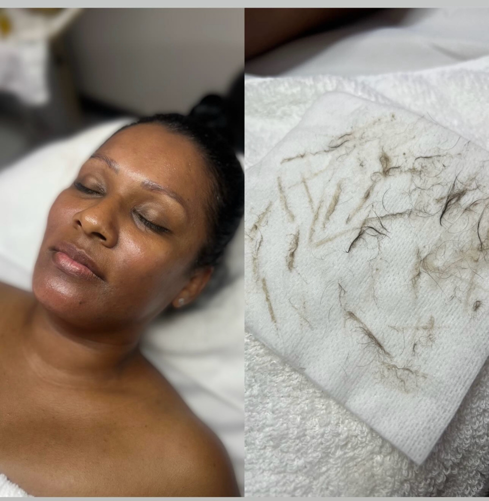 Dermaplane Facial