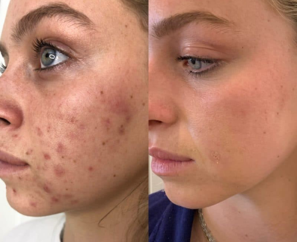 Deep Peel
