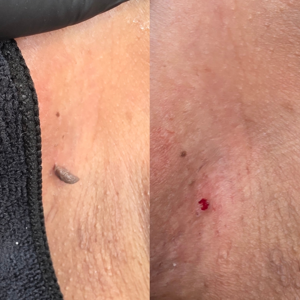Fibroblast Skin Tag removal at Downtown Wax Aesthetics in Chandler, AZ