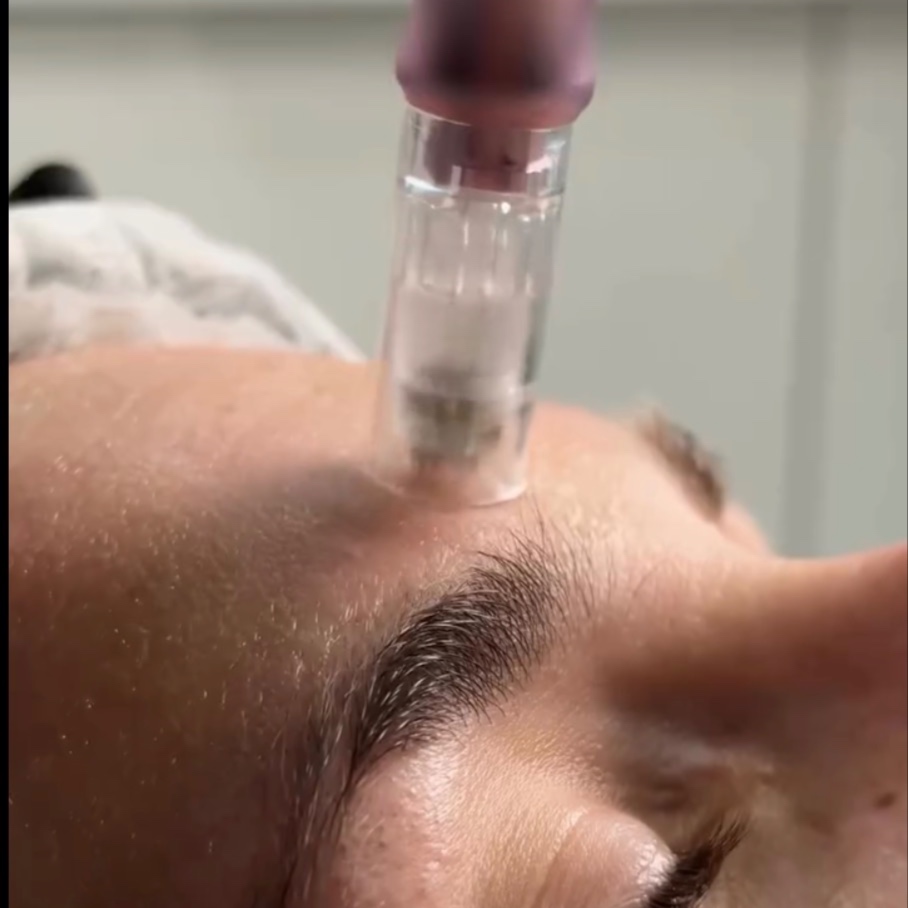 Advanced Microneedling at OpiAva in Austin, TX
