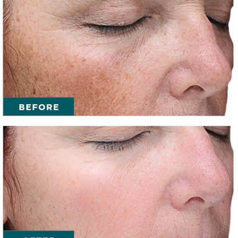 Vi Peel Chemical Facial Peel at Glam and Glow in Huffman, TX