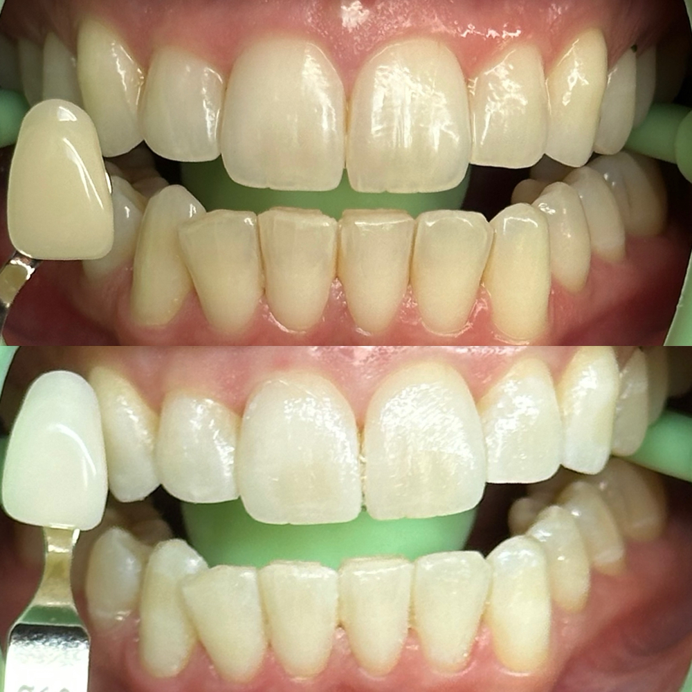 Radiant White Session at Beauty Lab Los Angeles in Los Angeles, CA