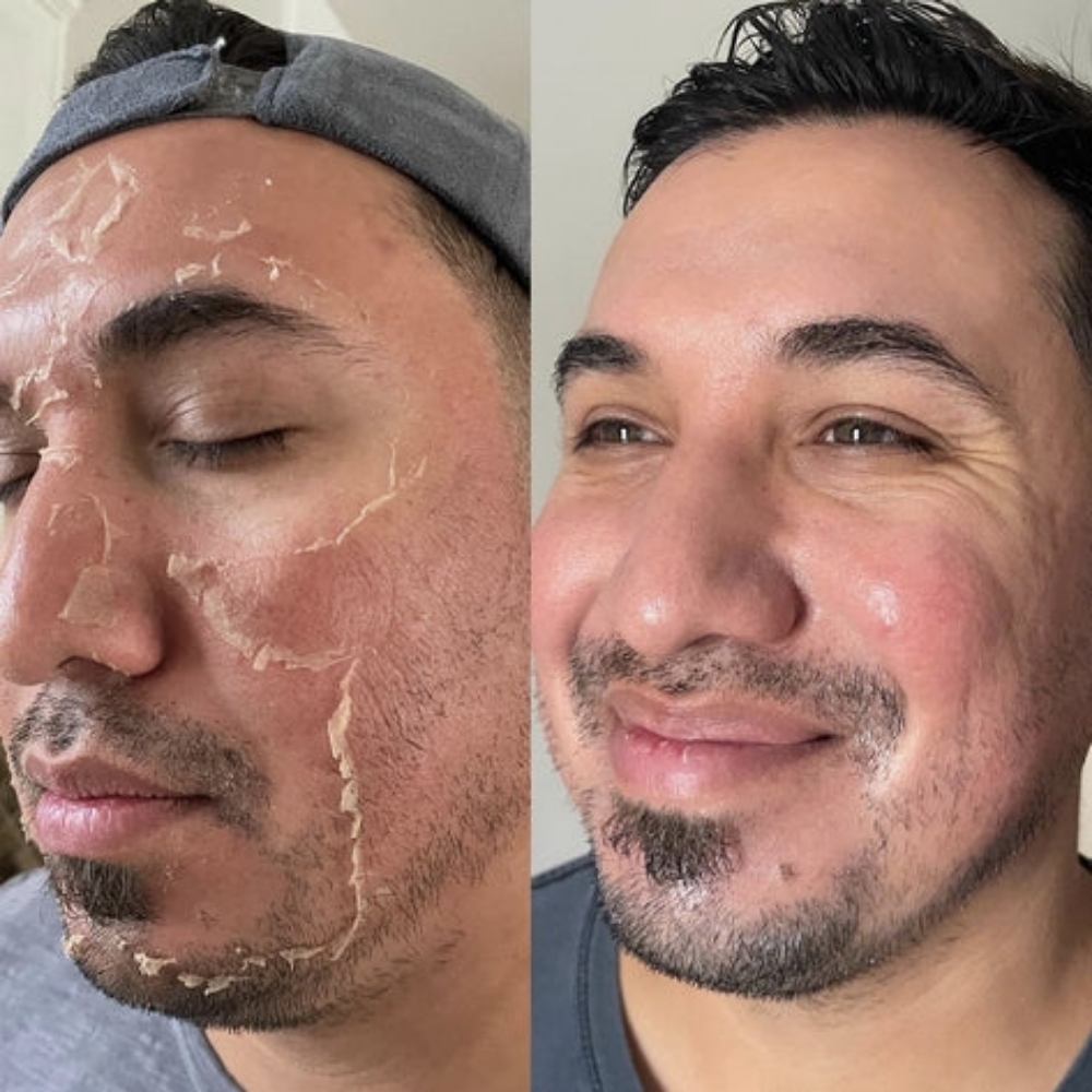 Chemical Peel at CQ Beauty & Esthetics in Modesto, CA