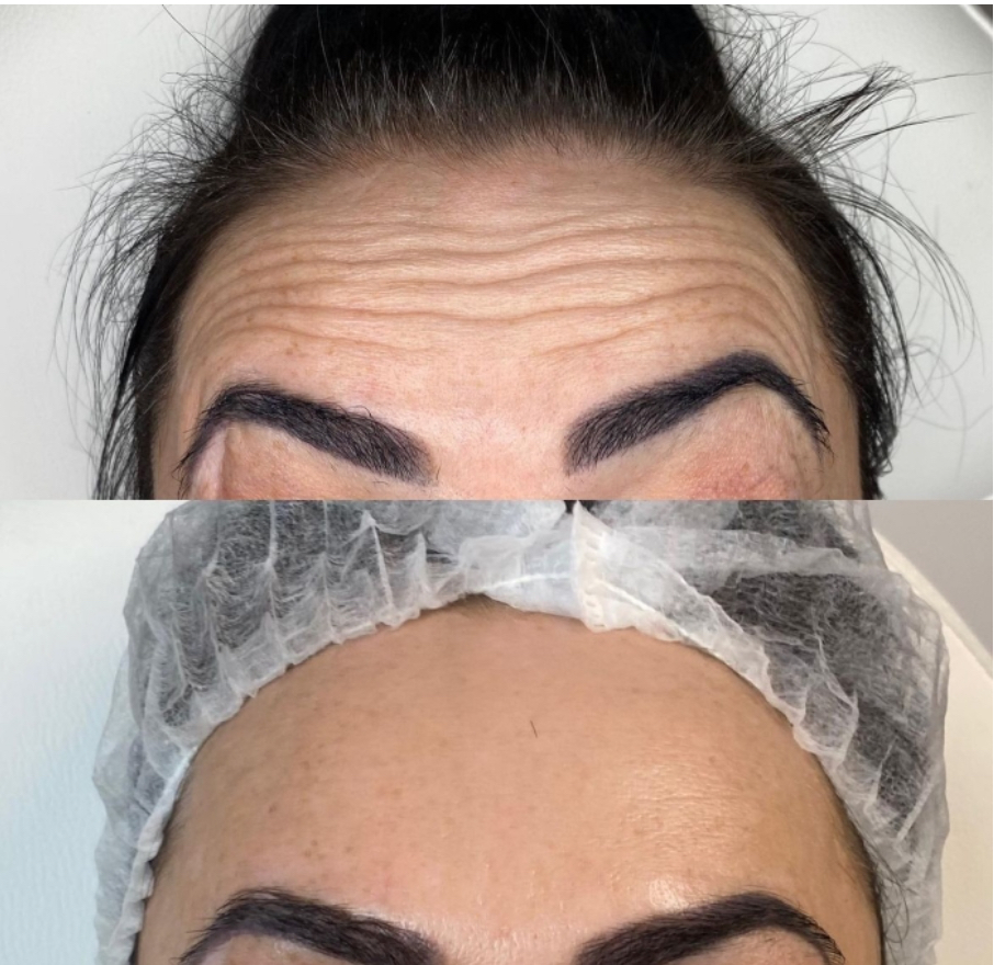 Botox