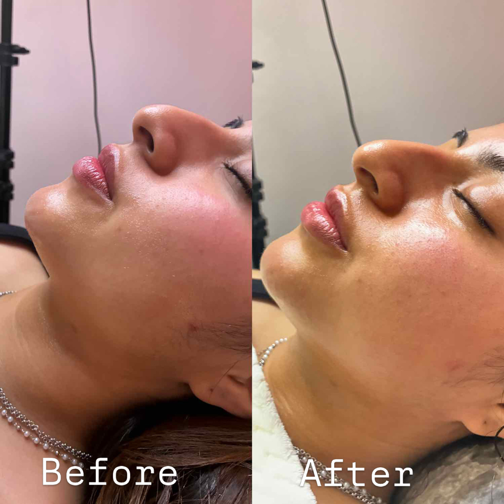 Rf Face Lift (full face) at Infiniteglowspa in Mesquite, TX