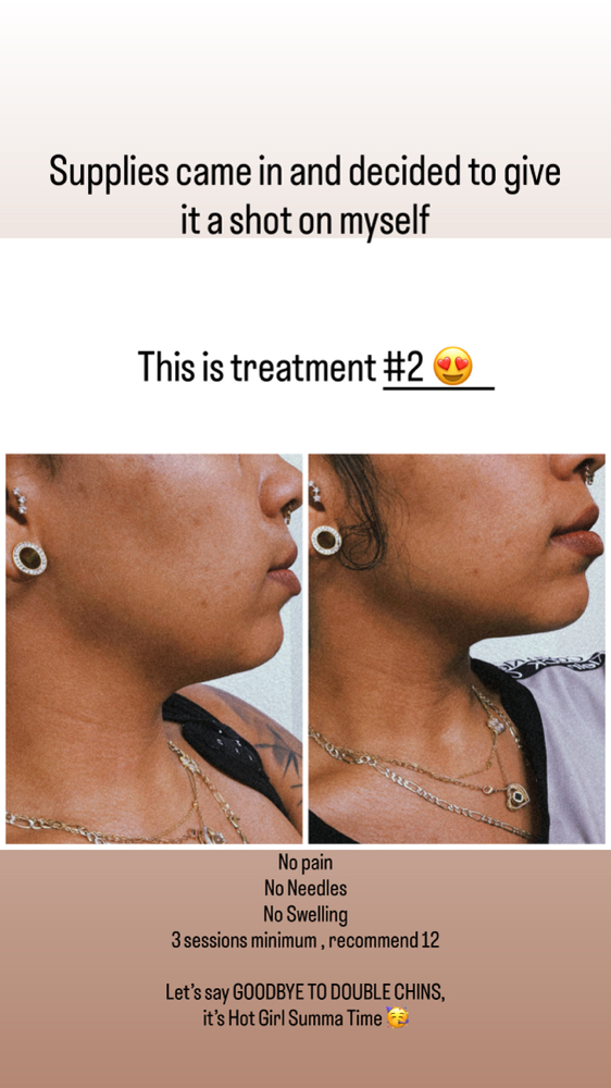 RF Double Chin Lipo (4) Sessions