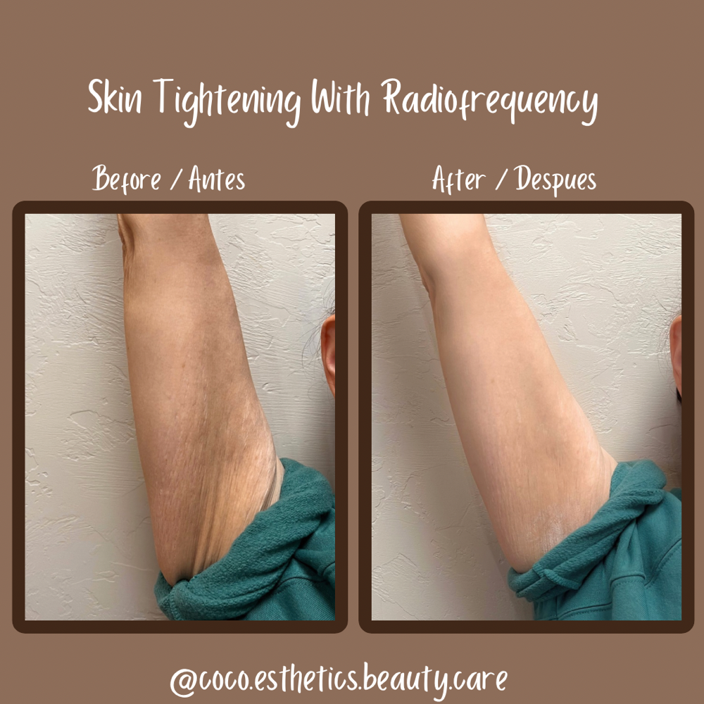 Skin Tightening With Radiofrequency