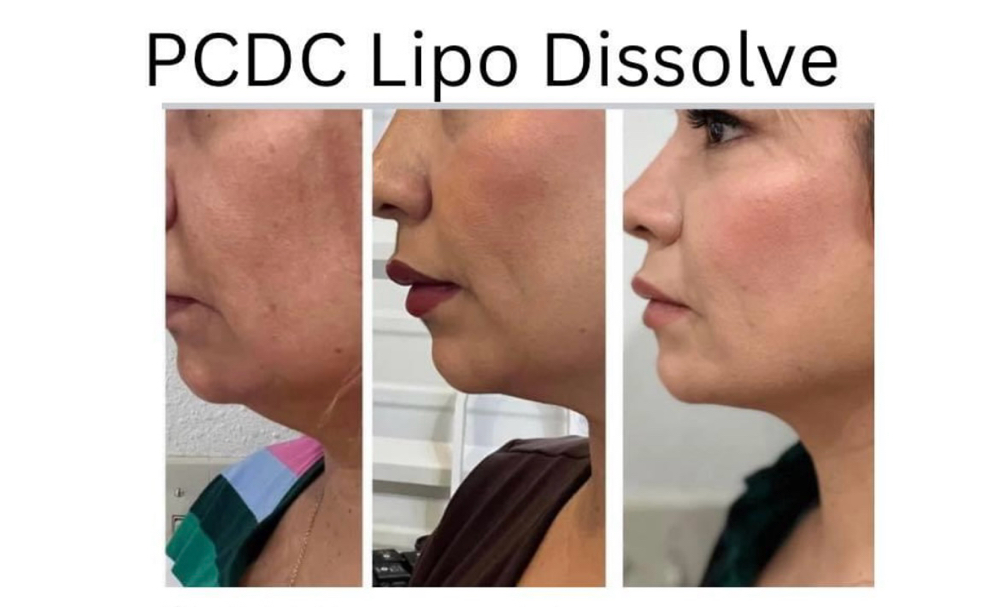 Fat Dissolver at 1111 Aesthetics & Wellness LLC in Irving, TX