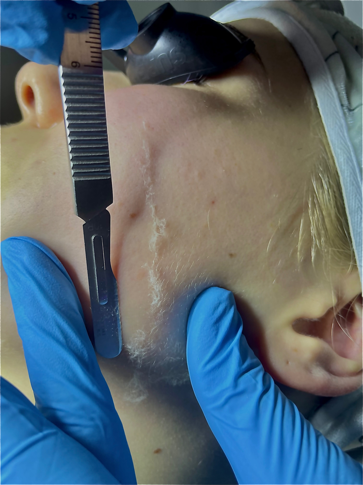 Dermaplane Facial