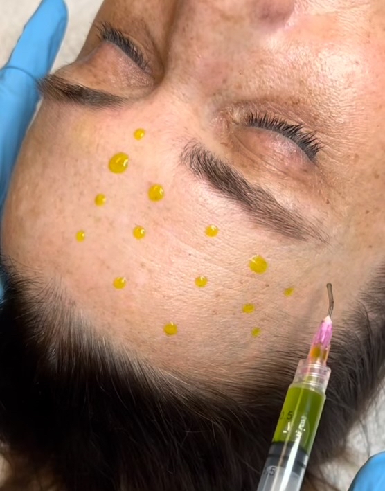 Bio RE None Peel (Bio Level) Peel