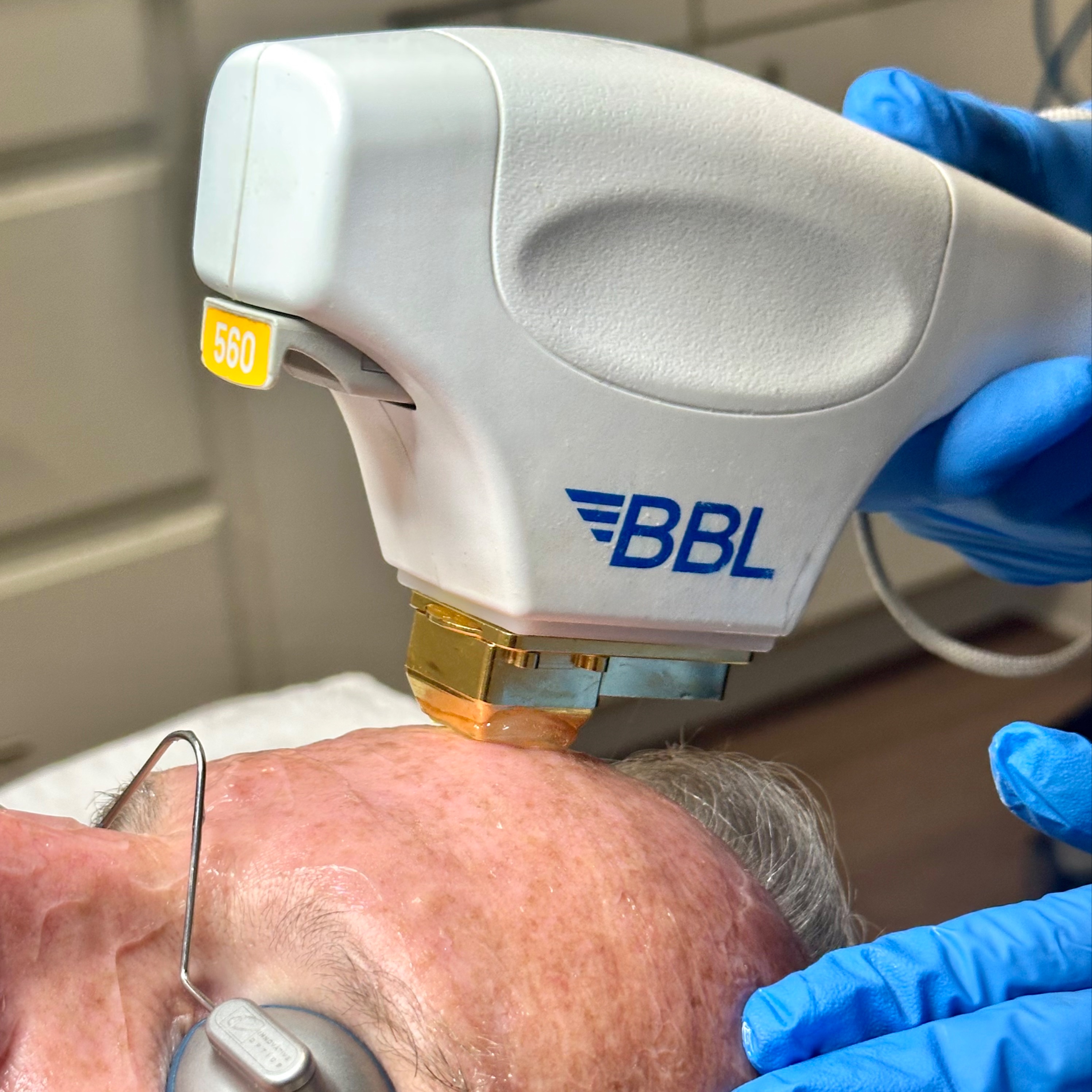BBL Face/Neck at The Skin Concierge in Northbrook, IL